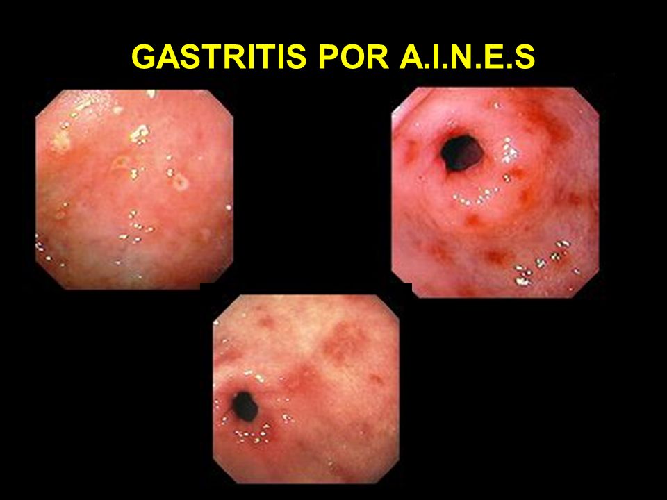 GASTROPATIA POR AINES EBOOK GASTROPATIA POR AINES EBOOK